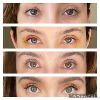 San Diego Eyelid Specialists - From top to bottom: before surgery, 5 days post, 1 month post, and 2 months post. - Plastic Surgeons Near Me - La Jolla, California San Diego Eyelid Specialists - From top to bottom: before surgery, 5 days post, 1 month post, and 2 months post. - Plastic Surgeons Near Me - La Jolla, California