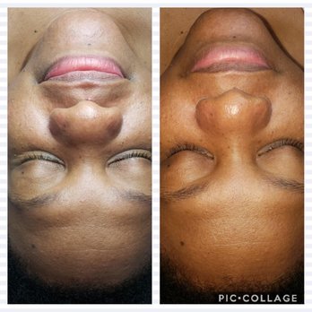 Kaesthetics Gold - Before and after - Skin Care Near Me - Jamaica, New York Kaesthetics Gold - Before and after - Skin Care Near Me - Jamaica, New York