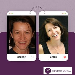 Ridgetop Dental - Sterling - Before and After cosmetic procedure.