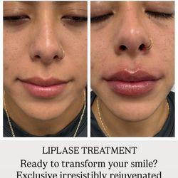 Oasis Luxury Med Spa - LIPLASE - Natural Lip Plumping with Laser!