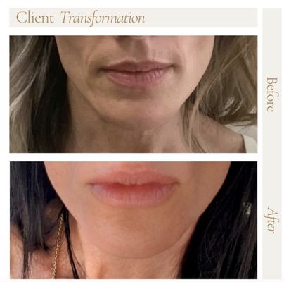 Botox & Filler - We offer filler to add volume to certain areas of the face as well as Botox to reduce and prevent wrinkles as well as to help with excess sweating or muscle tension. Botox & Filler - We offer filler to add volume to certain areas of the face as well as Botox to reduce and prevent wrinkles as well as to help with excess sweating or muscle tension.