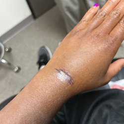 Premier Plastic Surgery - After - removed. small/minimal scar. Pain gone.