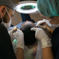 Miami Hair Transplant