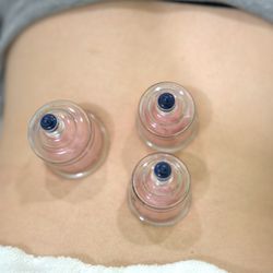 Bonheal Acupuncture - Aroma Cupping
