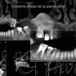 Christophe Nivière - Case report 1 Planification de 8 implants maxillaire pour une prothèse implant-portée de 14 dents.