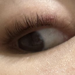 I got chemical burns on my eyes and when I said it was burning and asked if I could take it off I was told that was not an option. I got chemical burns on my eyes and when I said it was burning and asked if I could take it off I was told that was not an option.