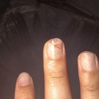 KV Nail Art - Broken bloody nail t - Nail Salons Near Me - Phoenix, Arizona