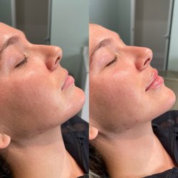 The Laser Lounge Spa Sarasota - Before and after 1 syringe of Restylane Kysse with Angie