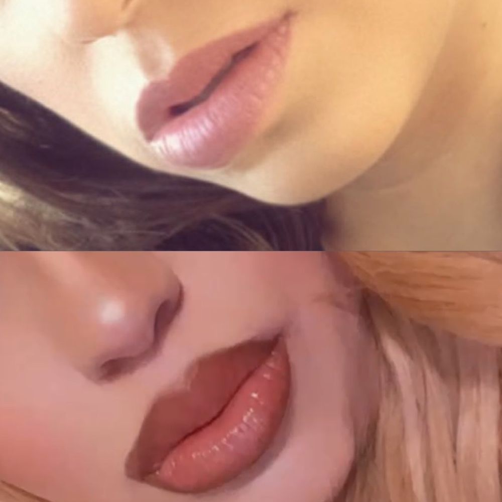 Sculpt - Lip fillers - Medical Spas Near Me - Los Angeles, California