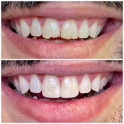 Stepan Harutyunyan, DMD - Glen Dental Studio - Natural repair of broken teeth.