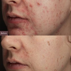 Focus - Acne & Skin Health.