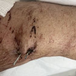 Concentra - Worst pain I have ever felt...after first surgery with Dr Bagwat