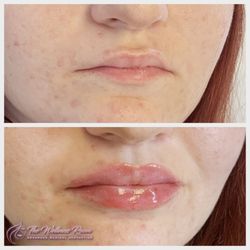 The Wellness Room - Lip filler