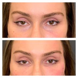 Ovo Medi Spa - Your eyes can make you look more tired. We use PRF, biostimulators, laser treatment,  RF microneedling, and filler to fix this issue.