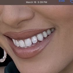 Shirin Etemadi, DDS - A Brilliant Smile - Pictured (3/16) is before my first visit with Dr. Etemadi. My teeth were shaped proportionately before ever seeing her