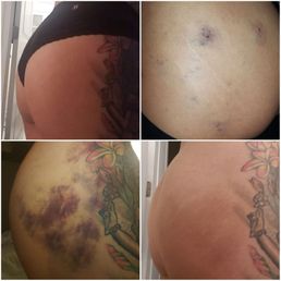 Top left: before Top right: right after injections/ bottom left : after 1 day bottom right : 8 weeks Top left: before Top right: right after injections/ bottom left : after 1 day bottom right : 8 weeks