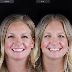 One Dental Studio - Smile Makeovers specializing in Porcelain veneers.