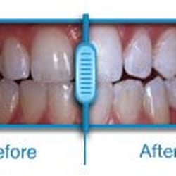 Boca Raton Modern Dentistry - Teeth Whitening