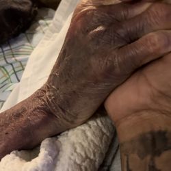 Moms hand after days in ICU from mis treatment un except able!