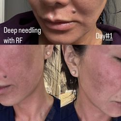 SkinRenuit Medspa - Deep needling day of treatment and day 1 post treatment. No downtime.