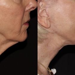 Secondary facelift by Christopher Ellstrom, M.D.