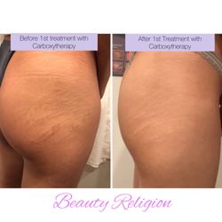 Beauty Religion - Before and after carboxytherapy for stretchmarks