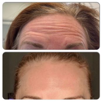 Alisa MedSpa - Botox done right! - Medical Spas Near Me - Brea, California Alisa MedSpa - Botox done right! - Medical Spas Near Me - Brea, California