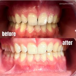 Mojgan Shokri, DDS - Mega Bite Dental - Same Day "Bonding" Procedure (Closed Gaps)
Visit megabitedental.com to schedule your Bonding Procedure today!