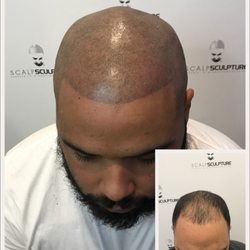 Scalp Sculpture - He got the youthful look he deserved.