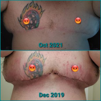 Oregon Cosmetic & Reconstructive Clinic - Nothing about this looks "natural" leaving me with breast tissue AND my disphoria!!! - Cosmetic Surgeons Near Me - happy valley, Oregon