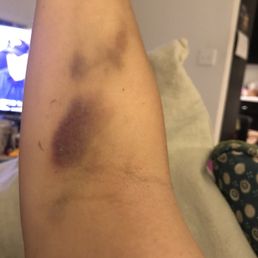 My arm the day after wisdom tooth removal from where the IV was! Very painful for days after the surgery.