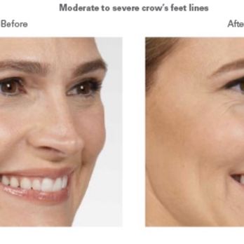 Vitaminfusion - Complete resolution of crows feet after one Botox treatment. - IV Hydration Near Me - Studio City, California Vitaminfusion - Complete resolution of crows feet after one Botox treatment. - IV Hydration Near Me - Studio City, California