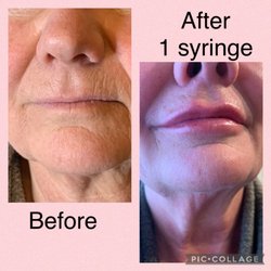 Whitefish Creative Aesthetics - Subtle before and after