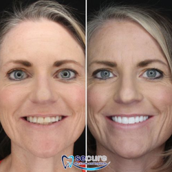 Secure Dentures and Implants - A new smile in one day!