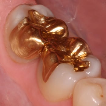 Murphy Sean, DDS - Gold is beautiful, and long lasting. - General Dentistry Near Me - Gig Harbor, Washington Murphy Sean, DDS - Gold is beautiful, and long lasting. - General Dentistry Near Me - Gig Harbor, Washington