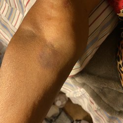 Barnes Jewish Hospital - BJC (main hospital): blown veins