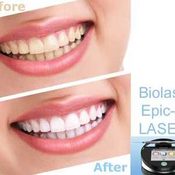 Diamond Bar Dental - Introducing Epic X Laser whitening to our office. Call our office for more information and take advantage of our April special!