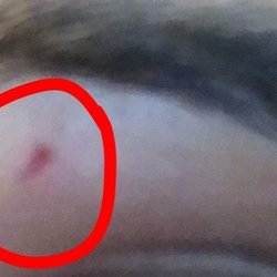 Arch 2 Arch - Most recent visit. Dec 8th 2018. Left with bleeding skin, and now scars.