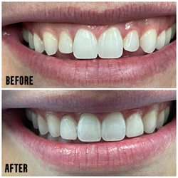 Only 2 veneers, what a difference!