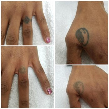 Reset Tattoo Removal - Before and after pics - Tattoo Removal Near Me - Las Vegas, Nevada Reset Tattoo Removal - Before and after pics - Tattoo Removal Near Me - Las Vegas, Nevada