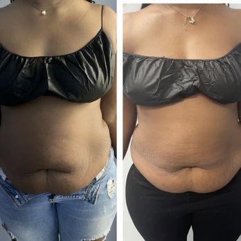 Spark Your Beauty - Body sculpting 2 session results. - Cosmetics & Beauty Supply Near Me - Lanham, Maryland Spark Your Beauty - Body sculpting 2 session results. - Cosmetics & Beauty Supply Near Me - Lanham, Maryland