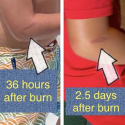 Plaza Mexico Restaurant Bar and Grill - Child's arm burned from very hot plate