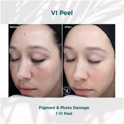 KGLO-Aesthetics - VI Peel treatment