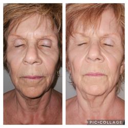 Seal Beach Massage & Wellness - Cryoskin Facial 5 treatments before and after