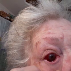 Retina Consultants of Nevada - Bad injection