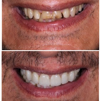 Advanced Dental Group - Full mouth reconstruction with crowns, veneers, and implants - Cosmetic Dentists Near Me - Edgewater, New Jersey