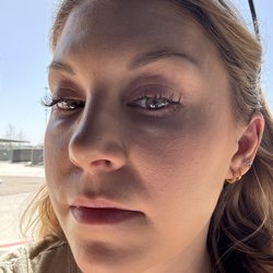 Ginger Allure MedSpa - Over 3.5 years after it was injected into my under eyes, unevenly