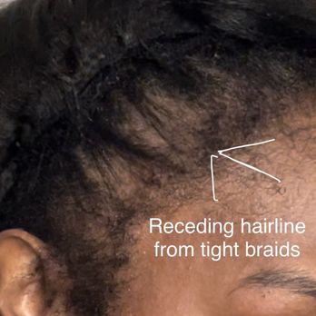 Destiny Hair Studio - Receding hairline on the left side of my head. Caused by tight braids. - Hair Salons Near Me - Bronx, New York Destiny Hair Studio - Receding hairline on the left side of my head. Caused by tight braids. - Hair Salons Near Me - Bronx, New York