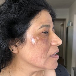 After my facial and she told me this is normal and it will heal by Thursday or Friday. After my facial and she told me this is normal and it will heal by Thursday or Friday.