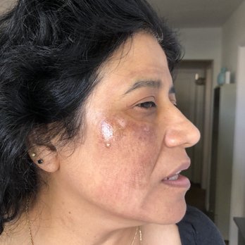 Zen Spa Aesthetics - After my facial and she told me this is normal and it will heal by Thursday or Friday. - Permanent Makeup Near Me - Torrance, California Zen Spa Aesthetics - After my facial and she told me this is normal and it will heal by Thursday or Friday. - Permanent Makeup Near Me - Torrance, California